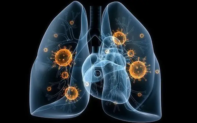 Hình minh họa phổi nhiễm virus, với các hạt virus màu cam bao quanh mô phổi trong không gian tối.