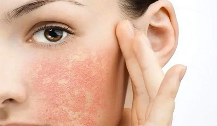 Người phụ nữ với da mặt bị đỏ và kích ứng, đặt tay lên má, thể hiện vấn đề da liễu.