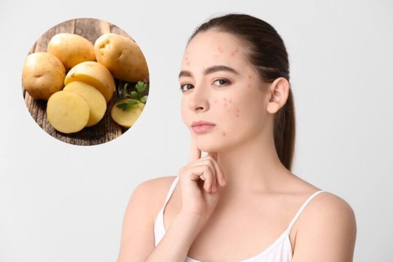 Trị Mụn Trứng Cá Bằng Khoai Tây: Top 14 Bí Quyết Làm Đẹp Hiệu Quả