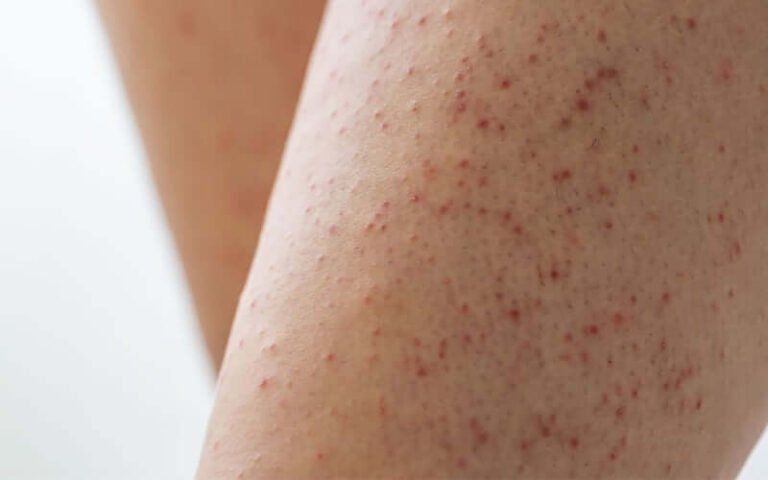 Nổi Mẩn Đỏ Sau Khi Wax Lông: Nguyên Nhân Và Cách Khắc Phục