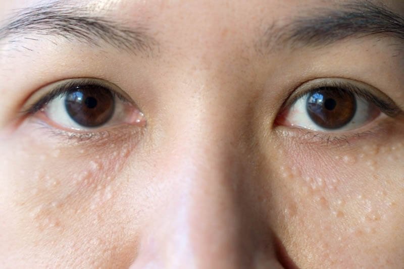 Cận cảnh đôi mắt với làn da xung quanh có nhiều nốt mụn nhỏ li ti.