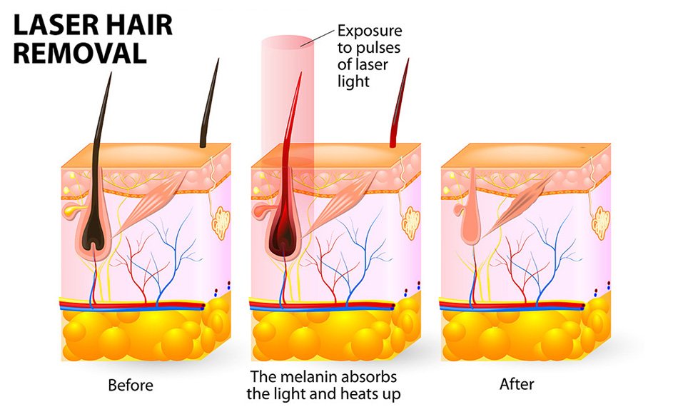 Hình minh họa quá trình tẩy lông bằng laser, gồm ba bước: trước, trong, và sau khi chiếu tia laser.