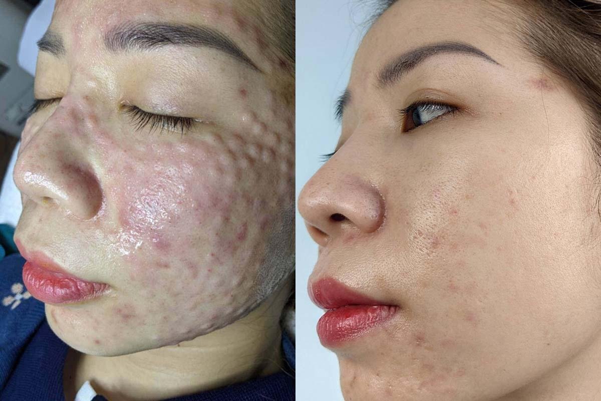 Hình ảnh trước và sau điều trị mụn, cho thấy sự cải thiện trên da mặt của một người.