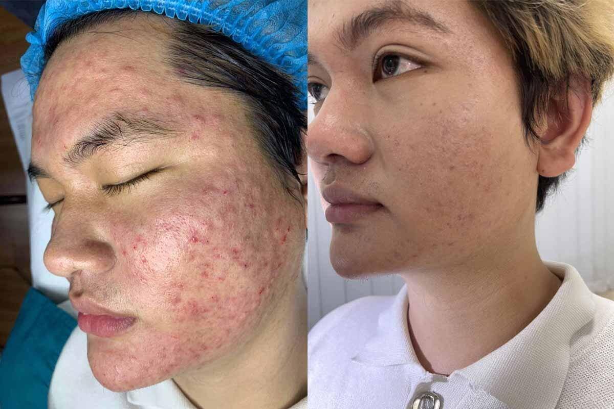 Hai hình ảnh khuôn mặt trước và sau khi điều trị mụn, thể hiện sự cải thiện làn da.