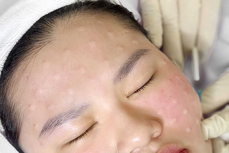 Người đang được chăm sóc da mặt, với nhiều nốt mụn từ liệu trình điều trị chuyên nghiệp.