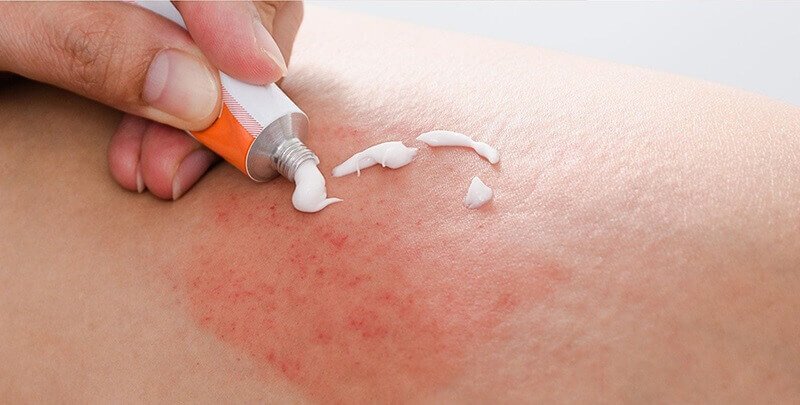 Người dùng bôi kem từ tuýp lên vùng da bị đỏ và kích ứng.