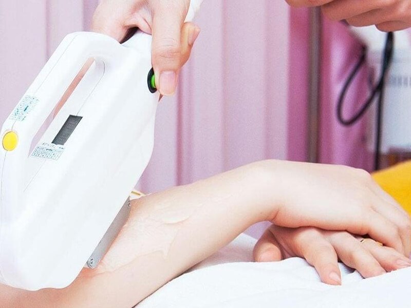 Thiết bị cầm tay đang chiếu tia laser lên da tay trong bối cảnh chăm sóc sắc đẹp.