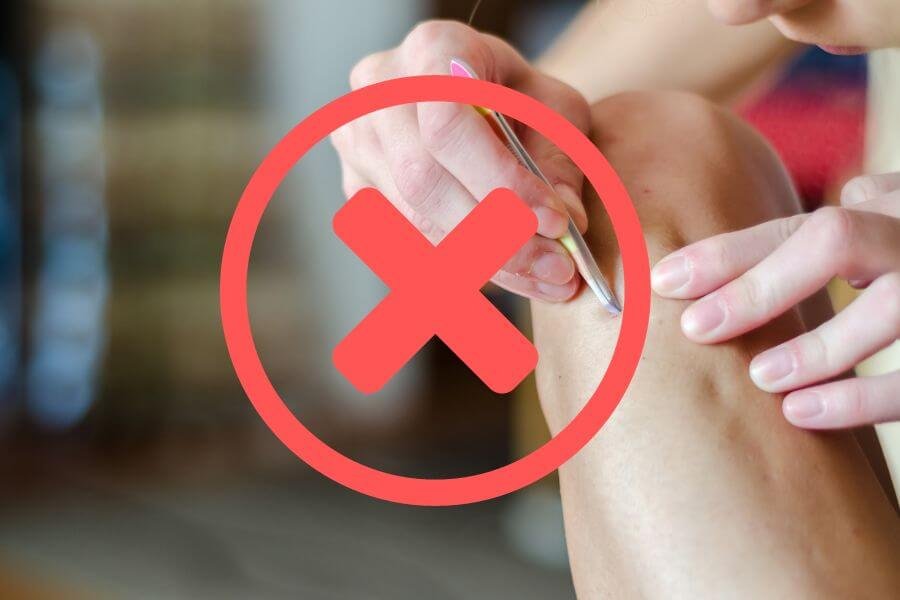 Người đang dùng nhíp gỡ vật thể khỏi da, với biểu tượng X đỏ phủ lên hình ảnh.