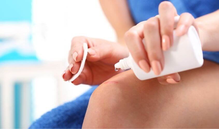 Người đang bôi thuốc sát trùng lên vết thương ở đầu gối bằng bông và chai nhựa trắng.
