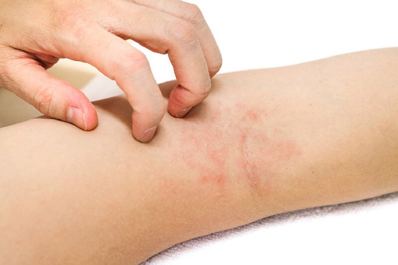 Người đang gãi vùng da bị mẩn đỏ và kích ứng trên cánh tay.