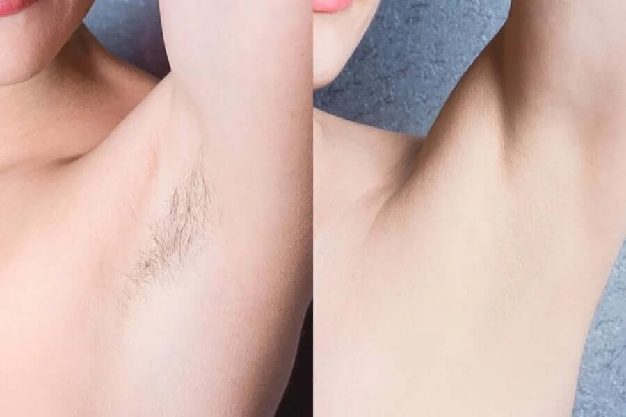 So sánh vùng da dưới cánh tay trước và sau khi triệt lông, với hình bên trái có lông và bên phải không có lông.
