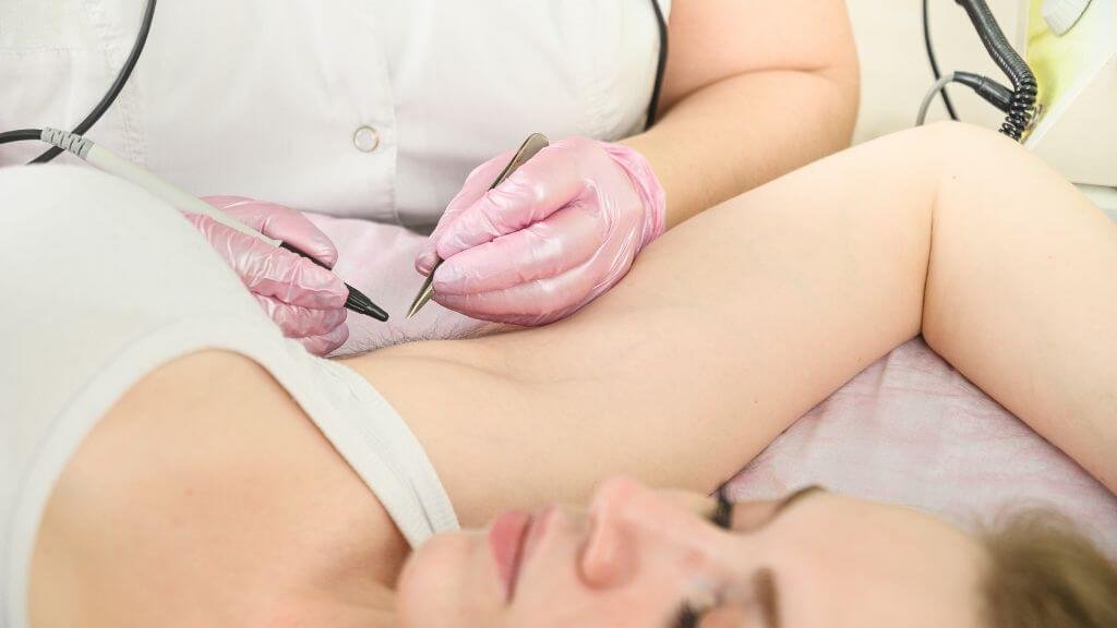 Nhân viên thẩm mỹ đeo găng tay hồng thực hiện liệu pháp laser dưới cánh tay cho một khách hàng nằm nghỉ.