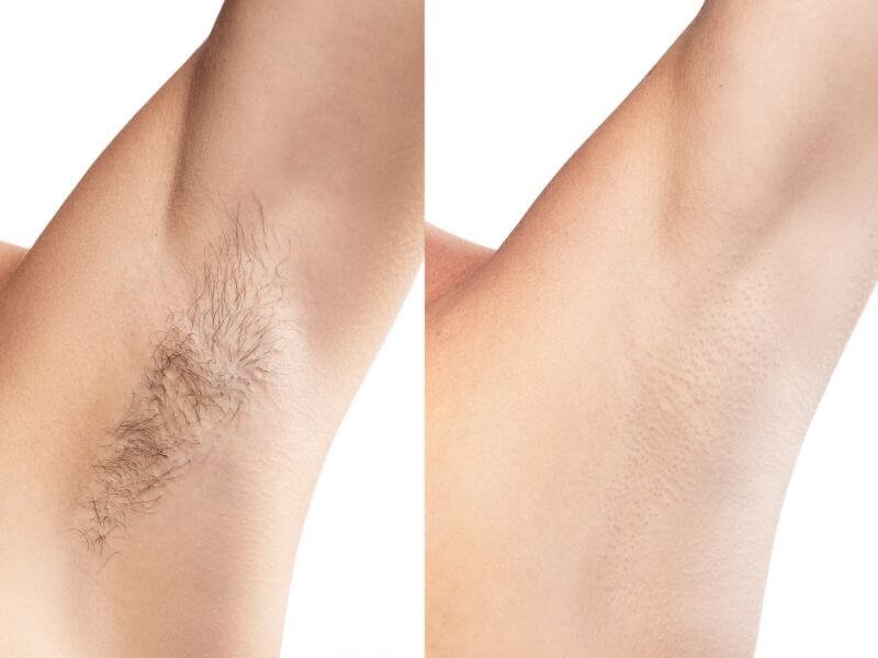 Hình ảnh so sánh vùng da dưới cánh tay trước và sau khi tẩy lông, bên trái có lông, bên phải không có lông.