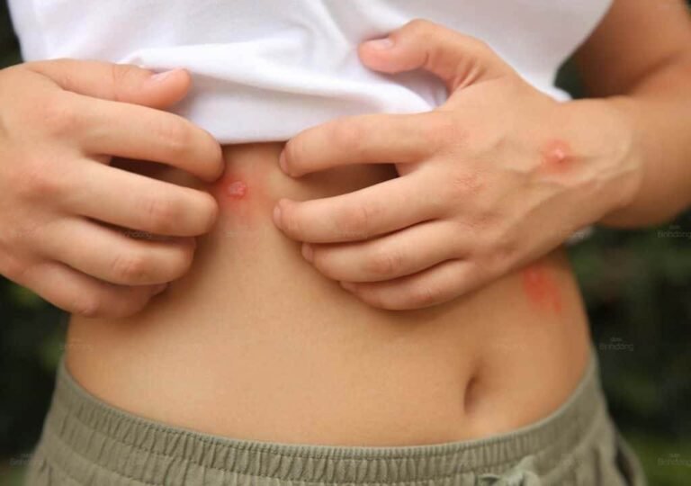 Mụn Nhọt Ở Bụng: Nguyên Nhân Và Cách Khắc Phục Nhanh Chóng