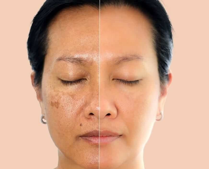 Nửa khuôn mặt với sự khác biệt về tình trạng da, bên trái có vết thâm, bên phải mịn hơn.