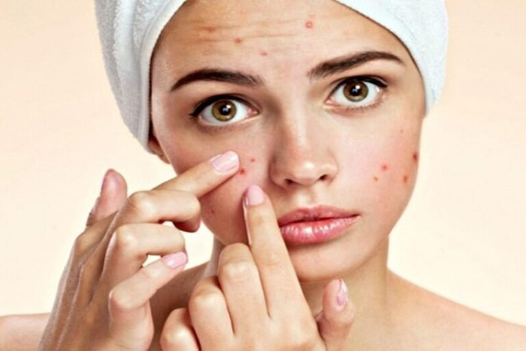 Bị Mụn Nên Ăn Rau Gì? Bí Quyết Chọn Thực Phẩm Cho Làn Da Sạch Mụn