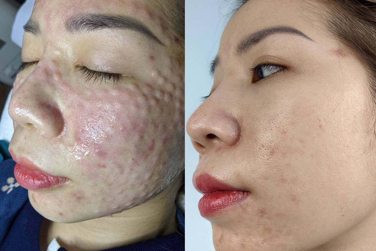 Hai hình ảnh khuôn mặt, trước và sau khi điều trị, cho thấy sự cải thiện rõ rệt về tình trạng da.