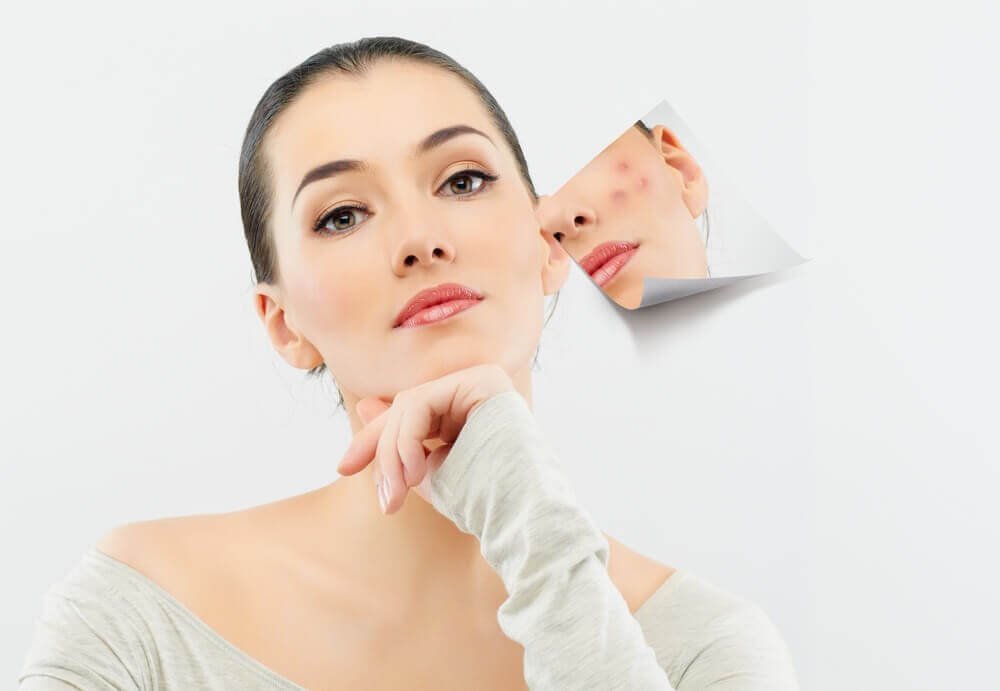 Người phụ nữ với làn da mịn màng, hình ảnh phản chiếu trên tấm gương cho thấy da bị mụn.