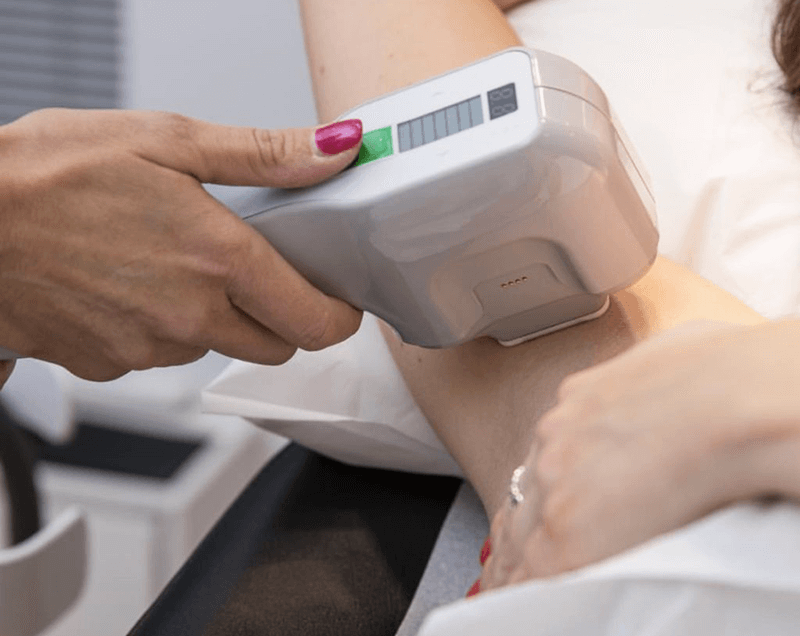 Người đang sử dụng thiết bị laser trên cánh tay trong một quy trình chăm sóc da.