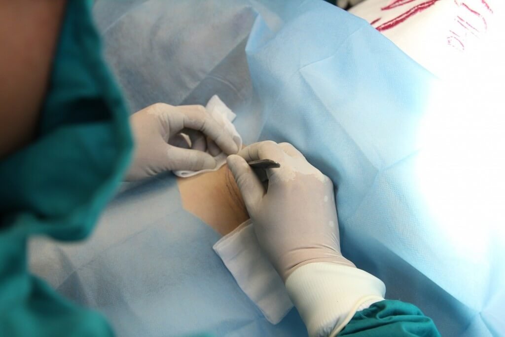 Nhân viên y tế đang thực hiện thủ thuật trên da bệnh nhân, đeo găng tay và sử dụng dụng cụ y tế.