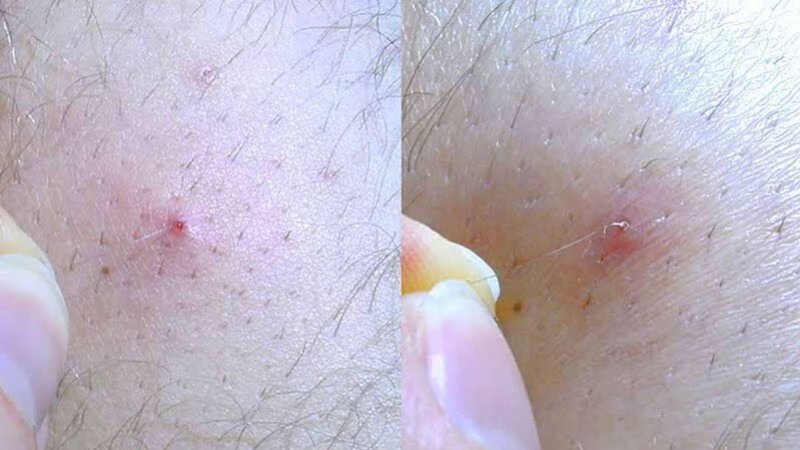 Hai hình ảnh về da với mụn đỏ, một hình có người đang nhổ một sợi lông mọc ngược.