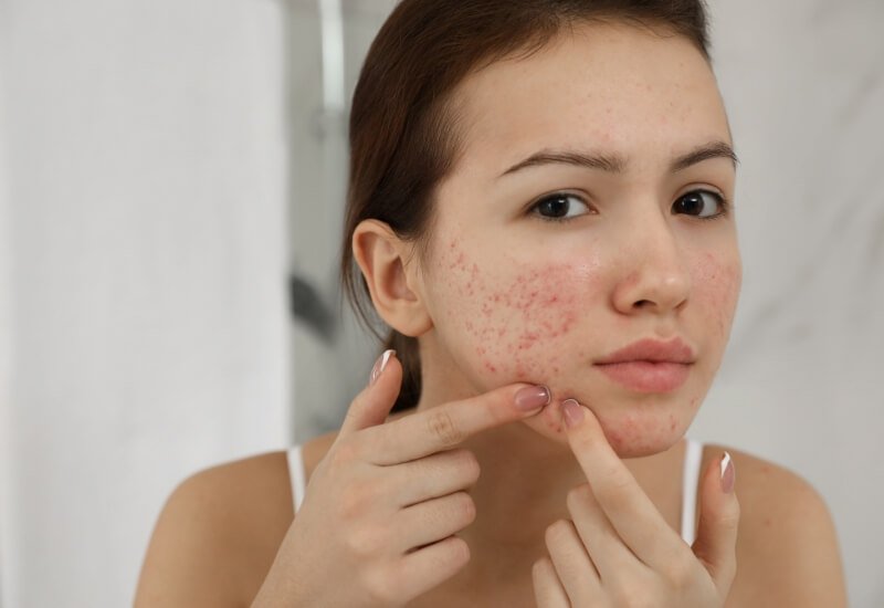 Người phụ nữ trẻ sờ vào vùng da mặt có nhiều mụn đỏ, chụp cận cảnh trong không gian có ánh sáng tự nhiên.