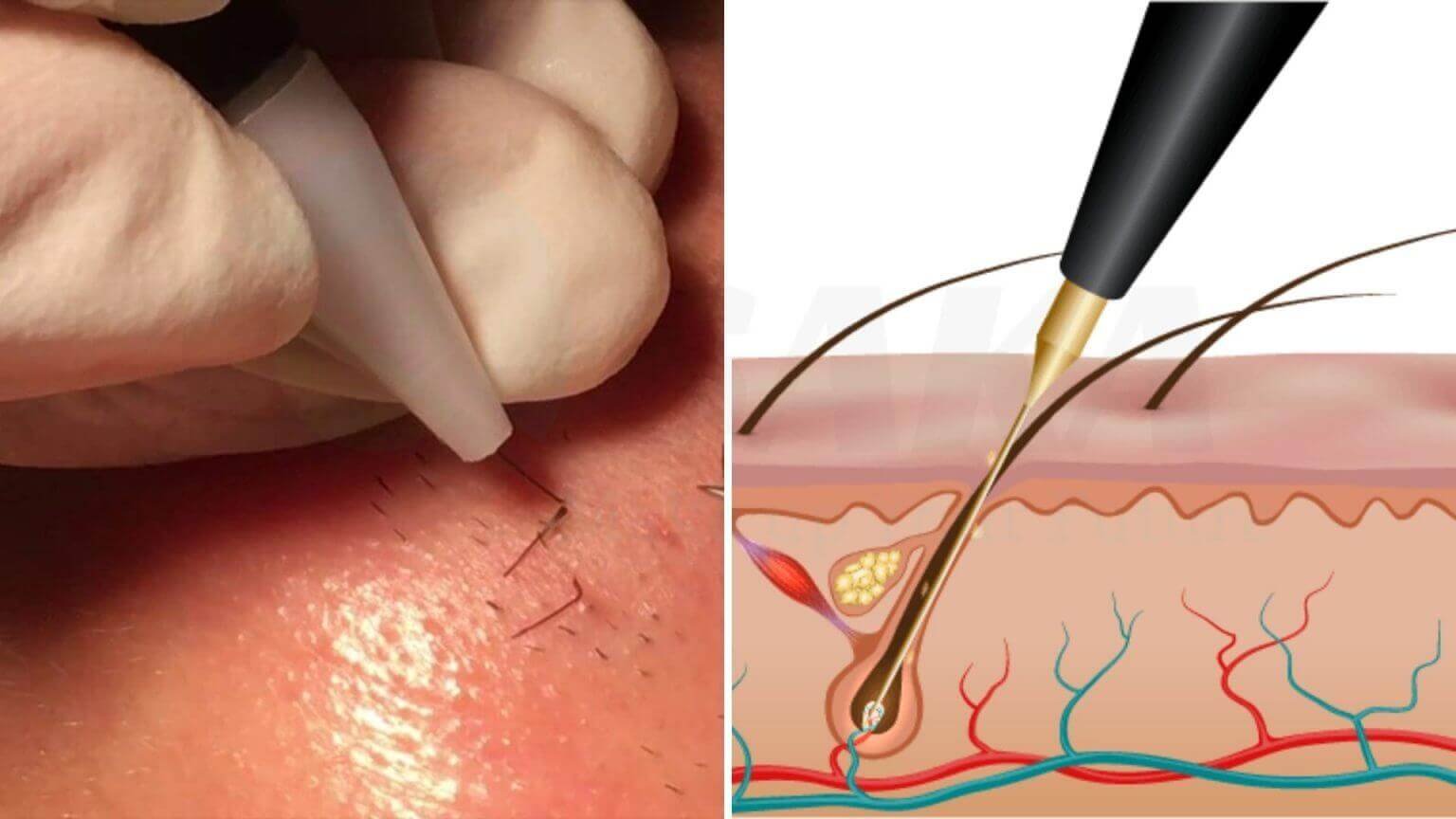 Hình ảnh mô tả quá trình triệt lông bằng điện, với một dụng cụ đang tác động lên da và lông.
