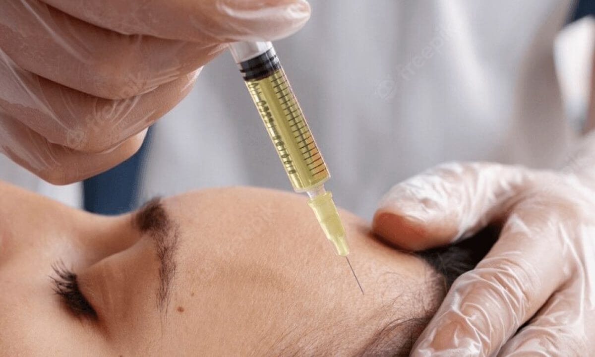 Người đeo găng tay đang tiêm chất lỏng vào vùng trán của người khác.