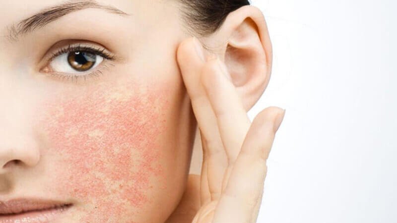 Cận cảnh một phần khuôn mặt với vùng da đỏ và khô, có bàn tay chạm nhẹ vào má.