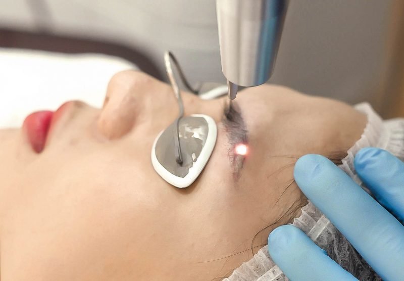 Người đang nhận liệu trình laser vùng lông mày, đeo kính bảo vệ, có người đeo găng tay xanh thực hiện.